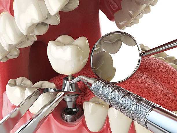 Best Urgent Care for Lost Fillings or Crowns in Lampasas, TX